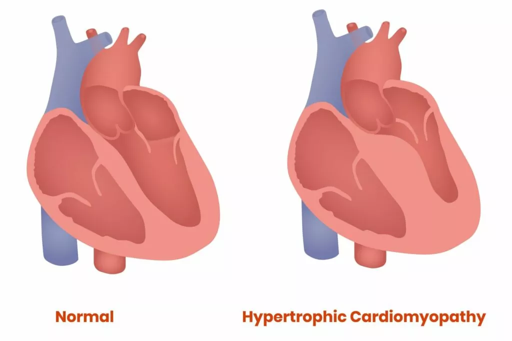infografika: prikaz normalnog i srca sa zadebljanjem